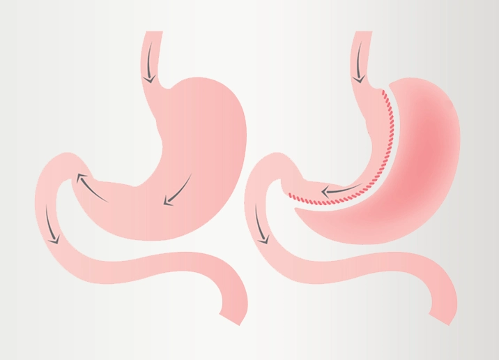 Opération de Sleeve Gastrectomie en Turquie