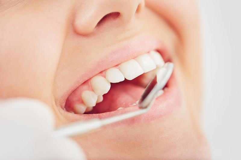 Un sourire éclatant grâce aux facettes dentaires en Turquie