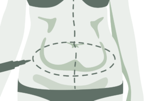 Lorsque le tissu conjonctif se relâche, une abdominoplastie peut aider