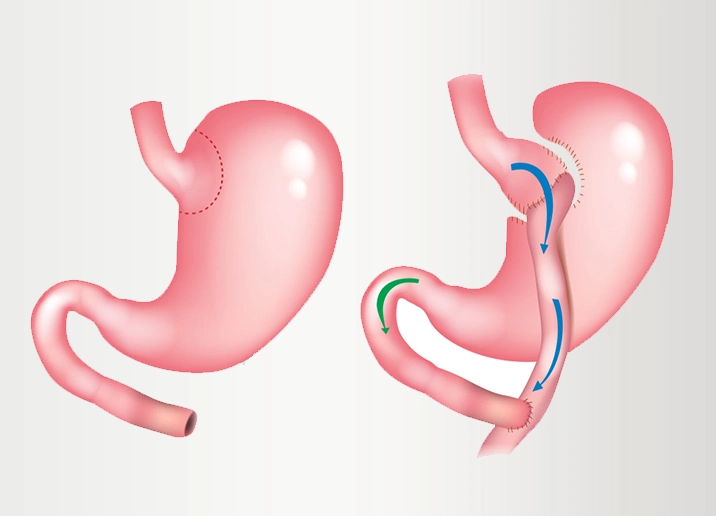 Bypass Gastrique en Turquie / Antalya – Coûts & Procédure