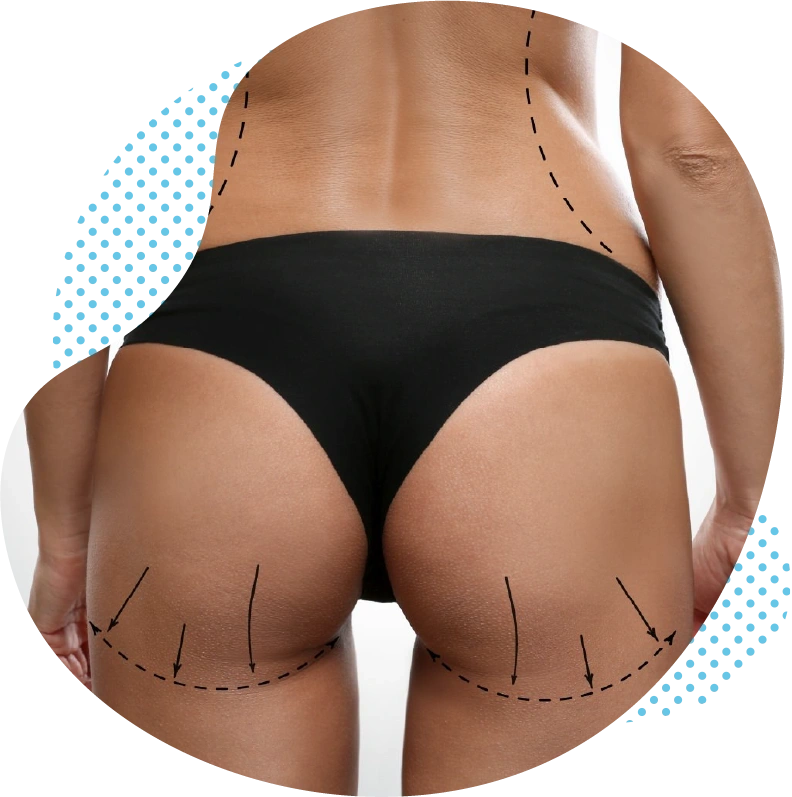 La BBL en Turquie – Déroulement