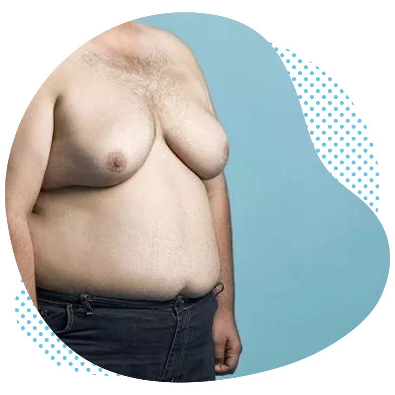 La gynécomastie en Turquie – procédure et technique