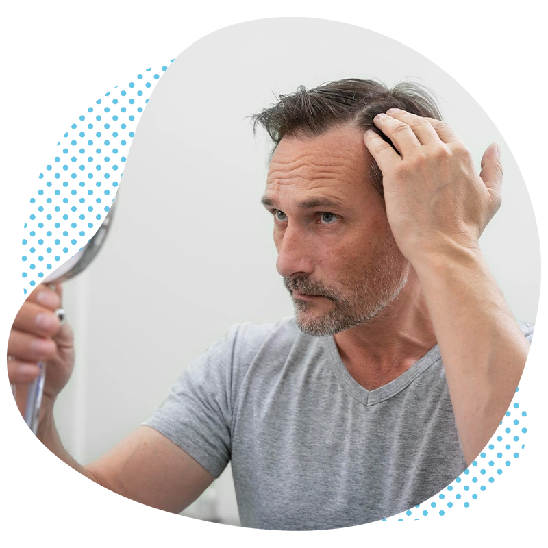 La greffe de cheveux DHI en Turquie – La voie vers une chevelure abondante