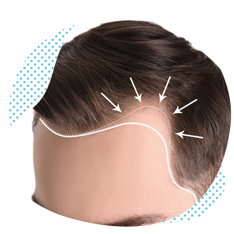 Quels sont les différents type de perte de cheveux ?