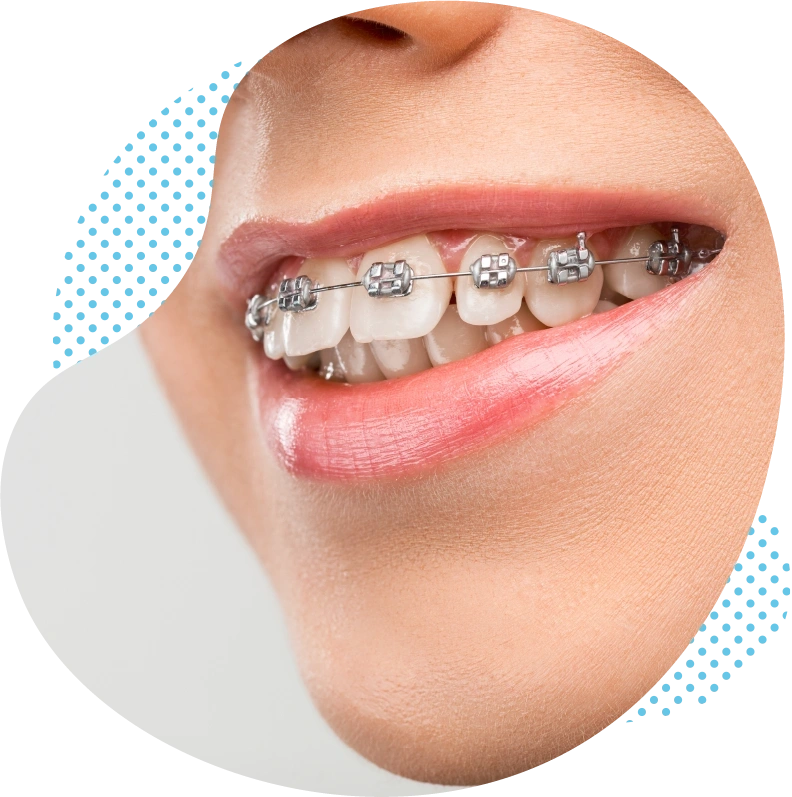 L’orthodontie générale pour les grands et les petits en Turquie