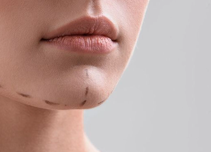 La correction du menton en Turquie / Antalya – Coûts & Procédure