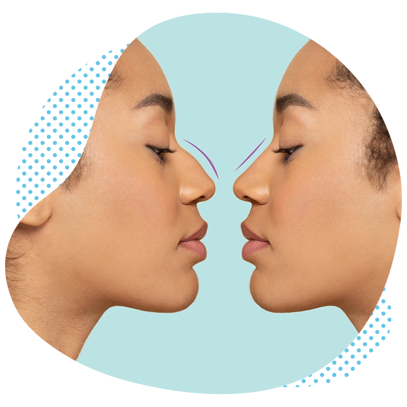 Comment se déroule une rhinoplastie ?