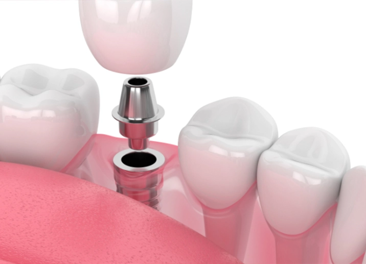 L’implant dentaire en Turquie